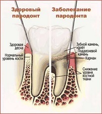 A periodontitis tünetei és kezelése, fotó, okai