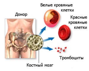 Csontvelő-transzplantáció - és milyen következményekkel jár, a költségek