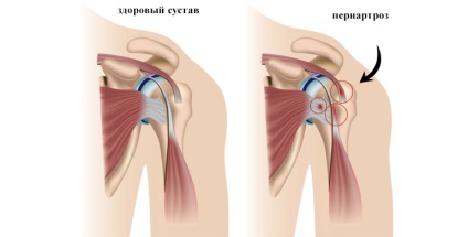 Periartroz vállízület - Kezelés, tünetei, okai