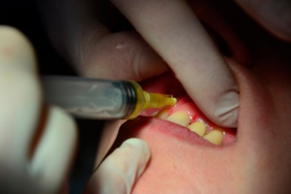 Plazmolifting fogászati ​​előnyeiről és hátrányairól, a valós orvosok