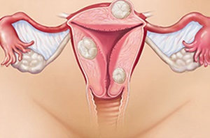 Miért fáj a dereka menstruáció előtt okoz, kezelés