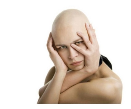 Miért az emberek menni kopasz volt az oka, alopecia (hajhullás) Miért az emberek mennek kopasz, a fő oka a hajhullás