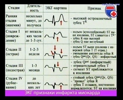 Szubakut fázisában miokardiális infarktus