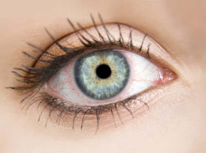 Bőrpír a szemét, amikor a kontaktlencse viselése, a cikk