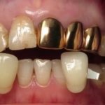 Hasznos tipp azoknak, akik szeretnék tudni, hogyan kell tartani a fogsor éjjel