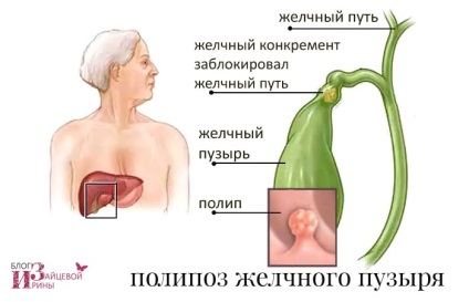 Polyposis epehólyag (polyposis) Polipok az epehólyag