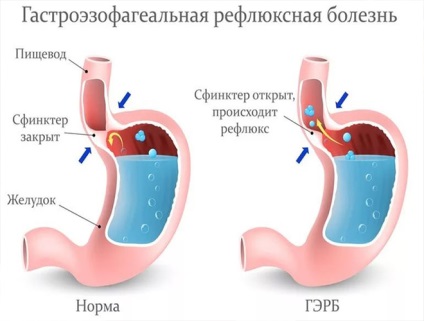 Constant gyomorégés okai, hogy ezt a gyakori rohamok égő