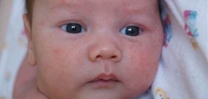 Malária az újszülöttben a nyakon vagy az arc, hogyan kell kezelni, fotó