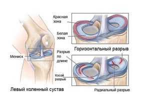 Kár, hogy a térd meniscus adott patológia, tünetek és kezelések