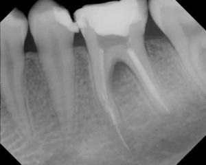 Az okok, amiért egy fogfájás kezelése után fogbélgyulladás, mit kell tenni