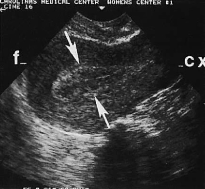 Jelek a méhnyálkahártya polip ultrahanggal