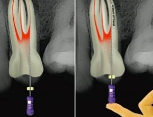 ProTaper a fogászatban (gépi és kézi titán fájlok) alkalmazásának sorrendjét