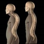 Kiemelkedés a lemez a nyaki gerinc okozza, tünetei, kezelése