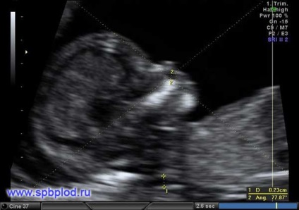 Megfejtése Uzi összehúzódások a terhesség alatt - blogomban beteshka