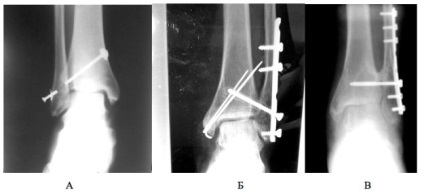 Tibiofibular syndesmosis szakadás - tünetek, kezelés