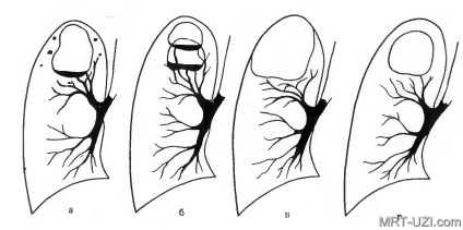 Mellkas röntgen infiltratív tuberculosis, miliáris, alopecia, MRI, ultrahang, X-ray