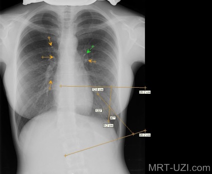 Mellkas röntgen infiltratív tuberculosis, miliáris, alopecia, MRI, ultrahang, X-ray