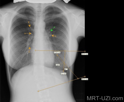 Röntgen infiltratív tüdő tuberkulózis, miliáris, fokális, MRI, ultrahang, X-ray (X-ray) Mellkas röntgen infiltratív tuberculosis, miliáris, alopecia, MRI, ultrahang, X-ray