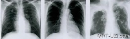 Röntgen infiltratív tüdő tuberkulózis, miliáris, fokális, MRI, ultrahang, X-ray (X-ray) Mellkas röntgen infiltratív tuberculosis, miliáris, alopecia, MRI, ultrahang, X-ray