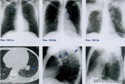 Mellkas röntgen infiltratív tuberculosis, miliáris, alopecia, MRI, ultrahang, X-ray