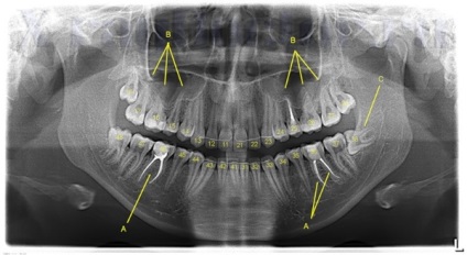 OPG röntgensugarak (orthopantomography), mi az, hogy lehet látni a képeken