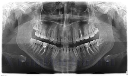 OPG röntgensugarak (orthopantomography), mi az, hogy lehet látni a képeken