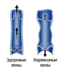 Reticular visszér, hogy tegye