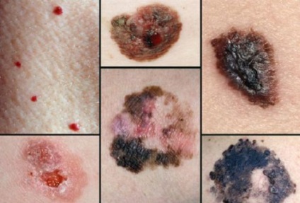 A vakond és a melanoma, hogyan lehet megkülönböztetni jelei rákmegelőző növedékek