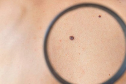 Mol, melanoma, hogyan lehet megkülönböztetni a jeleket a tünetek