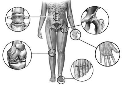 Az artritisz tünetei teljes leírása az összes jellemző funkciók