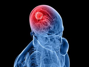 A tünetek és a kezelés az agydaganatok