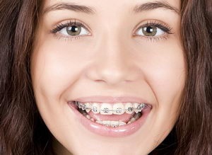 Konzolok a fogakra, hogy korrigálja a malocclusion - ez körülbelül a korrekció a malocclusion és fogszabályozó