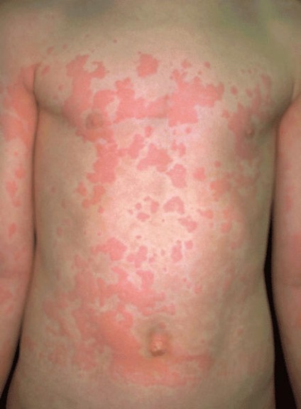 Sorbents allergia felnőttek - jobb gyerek, gyógyszerek