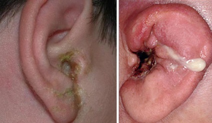Aureus a fülben - kezelés és a fertőzés tünetei fotóeffektus