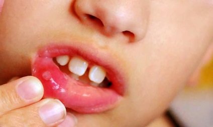 Stomatitis tünetek a nyelv, okok és kezelések