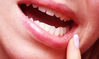 Stomatitis tünetek a nyelv, okok és kezelések