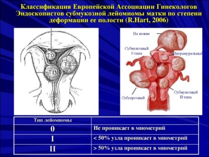 Nyálkahártya alatti myoma csomópont (csomópontok submucosus myoma) Nyálkahártya alatti myoma csomópont