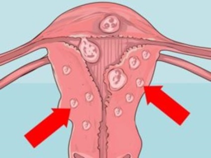 Nyálkahártya alatti myoma csomópont