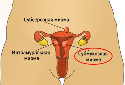 Nyálkahártya alatti myoma csomópont (belső réteg a méh) Nyálkahártya alatti myoma csomópont