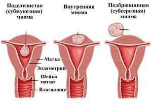 Nyálkahártya alatti myoma csomópont (myoma) Nyálkahártya alatti myoma csomópont