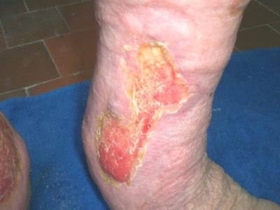 A láb trofikus fekélyének kezelése. Trofikus fekélyek cukorbetegség esetén