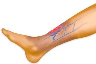 Trofikus fekély a lábon: fizioterápiás kezelés - Megelőzés November