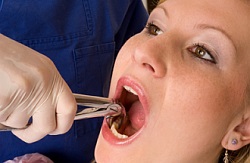 Eltávolítása a fog a beültetés előtt (mielőtt foghúzás) Tooth extrakciós beültetés előtt