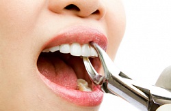 Eltávolítása a fog a beültetés előtt (implantáció) Tooth extrakciós beültetés előtt