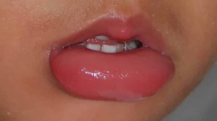 Az ajkak fájdalma - okai, diagnózisai, tanácsai és kezelése.