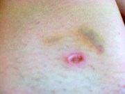Care eltávolítása után papilloma (utána) Ellátás után Szemölcsdaganatok