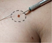 Care eltávolítása után papilloma (eltávolítás) Ellátás után Szemölcsdaganatok