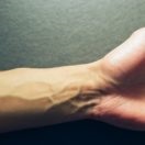 A visszértágulat a kezét - kezelés, tünetei és okai