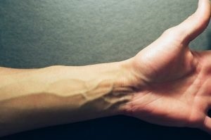 A visszértágulat a kezét - kezelés, tünetei és okai