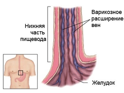 Visszértágulat a nyelőcső tünetek és kezelés